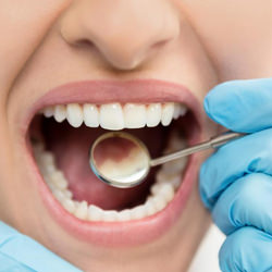 Tooth Decay